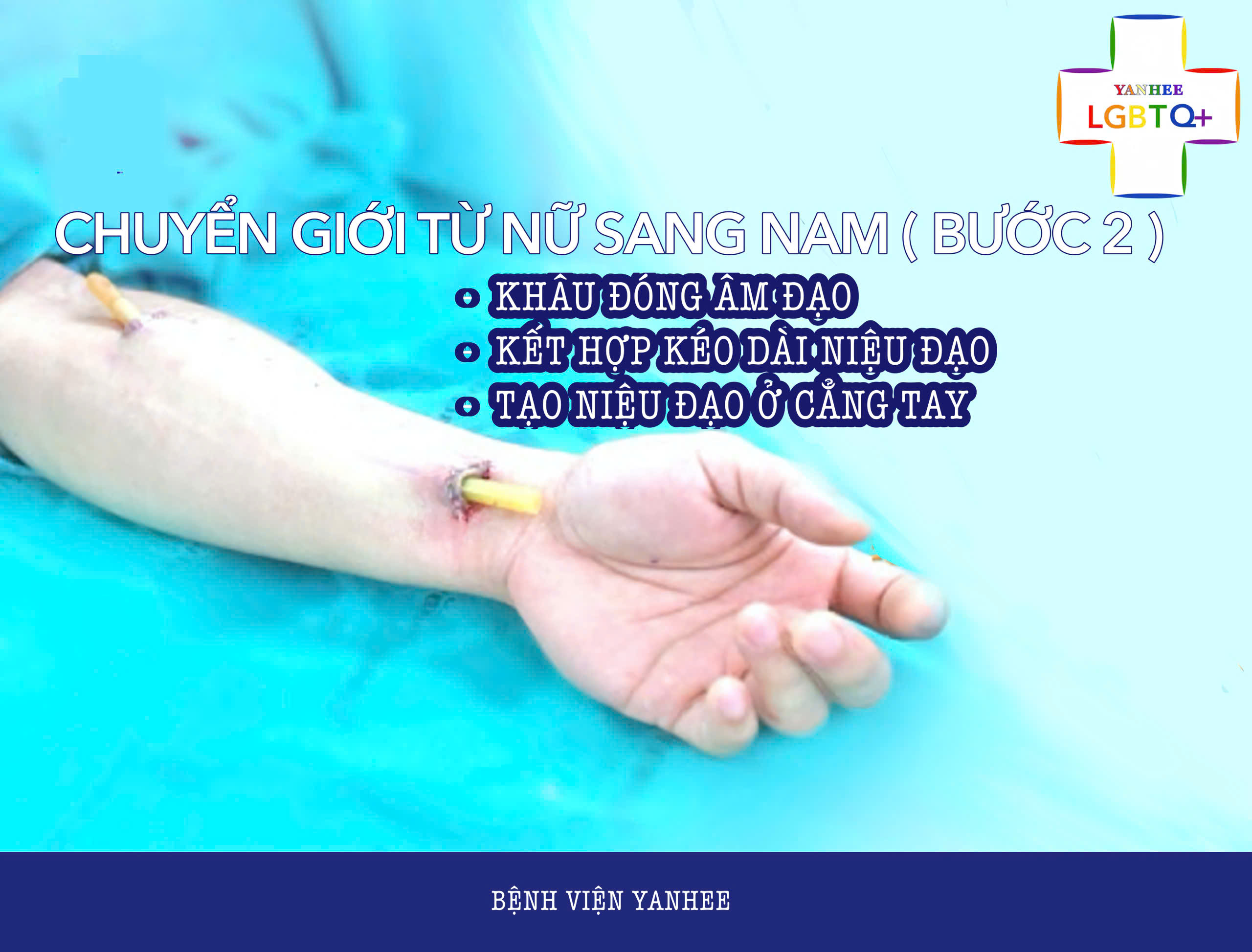 Khâu đóng âm đạo, kéo dài niệu đạo và tạo niệu đạo ở cẳng tay (Bước 2)